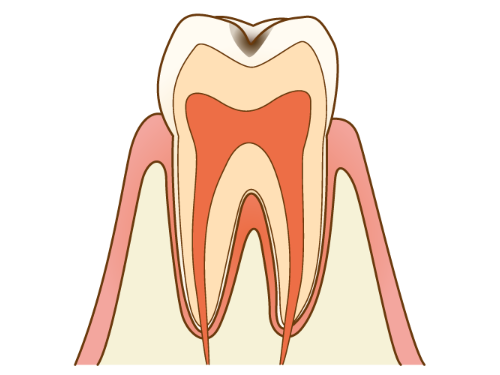 C1 - むし歯の初期状態