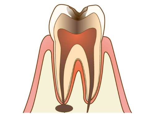 C3 - むし歯の後期状態