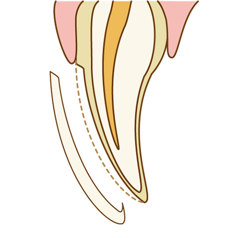 ラミネートベニア