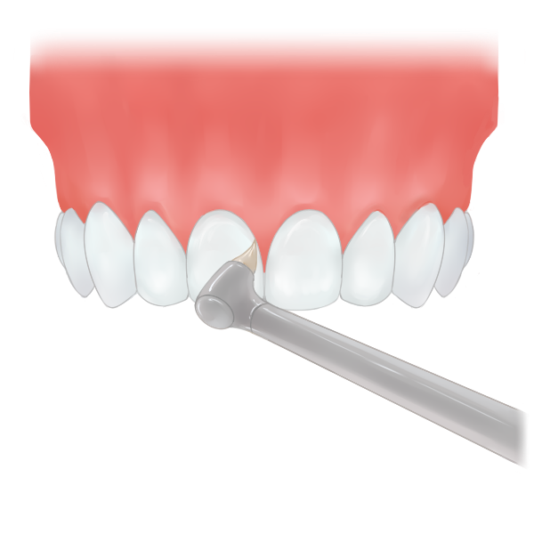 STEP1 チェックと歯間の清掃
