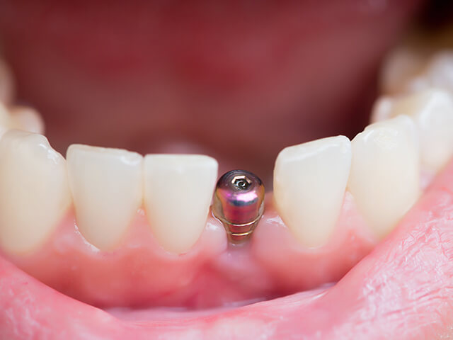 STEP2 インプラントの埋め込み