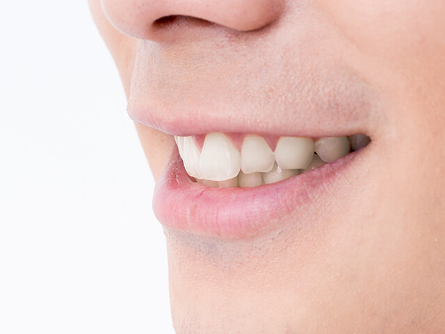 STEP3 人工の歯の取り付け