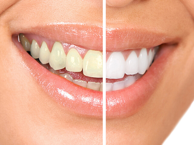 ホワイトニングとは