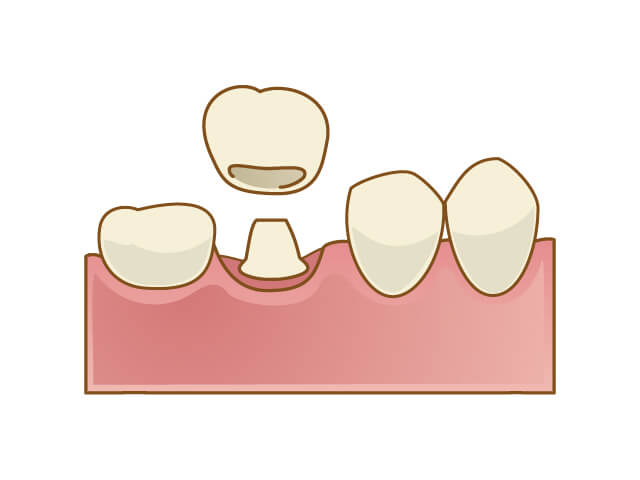 セラミッククラウン