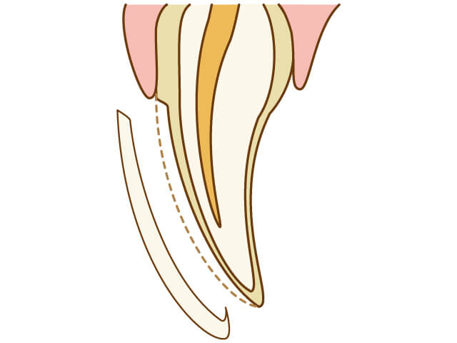 ラミネートベニア