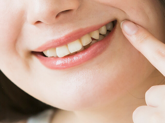 オールセラミック