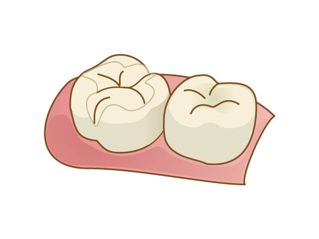 セラミックインレー