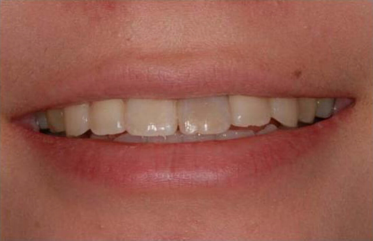 治療前の口元イメージ画像