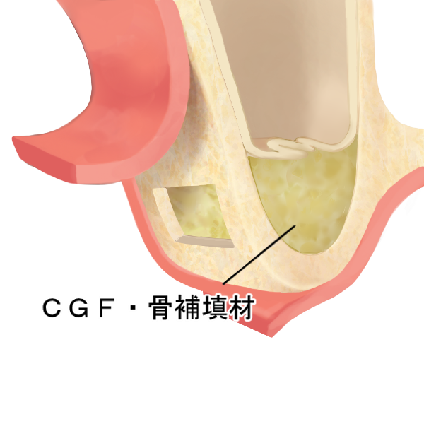 STEP1　歯肉と骨の除去と骨補填剤の充填