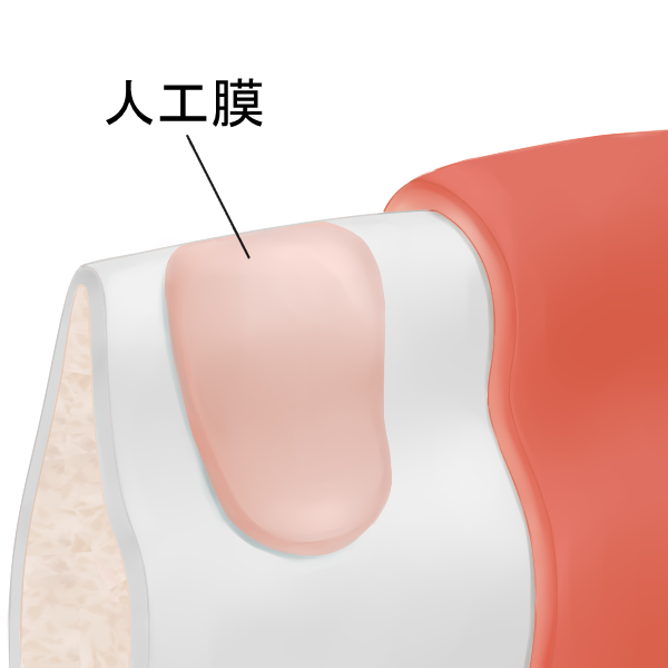 STEP2　メンブレン（人工膜）で露出部分を覆う