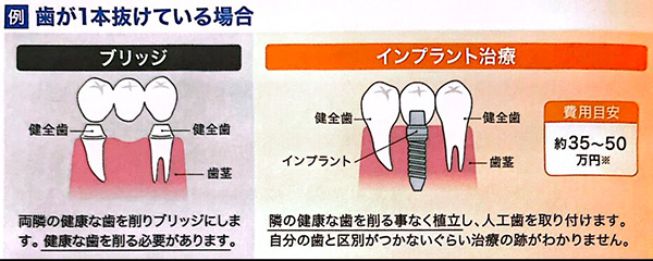 歯が1本抜けている場合