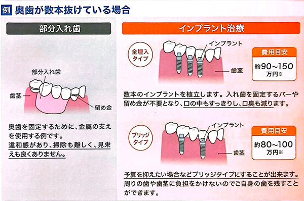 奥歯が数本抜けている場合