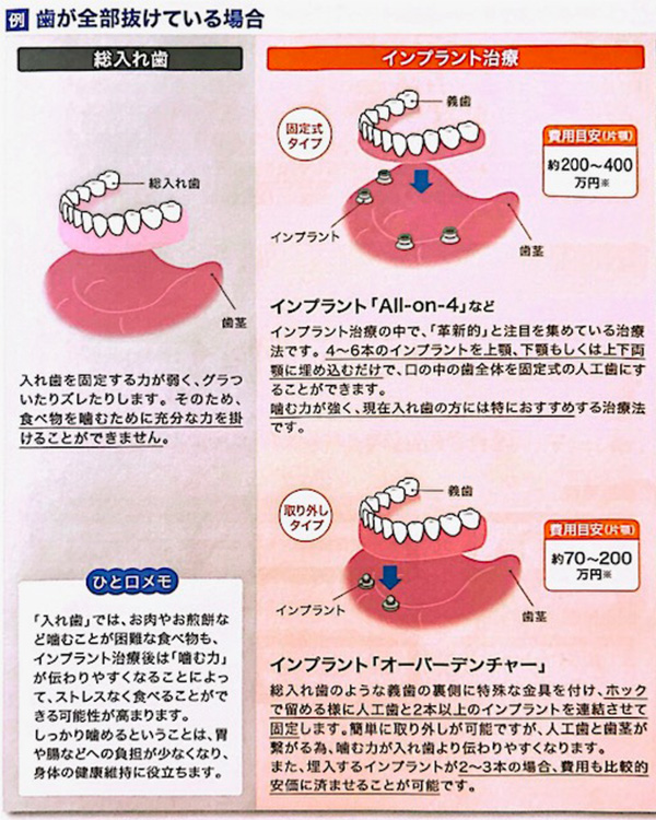 歯が全部抜けている場合