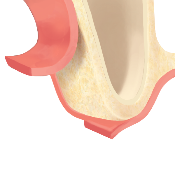 上顎洞の底部分を押し上げ骨を生成する手術