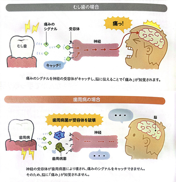 歯周病が進むほど、痛みを感じなくなり ます。