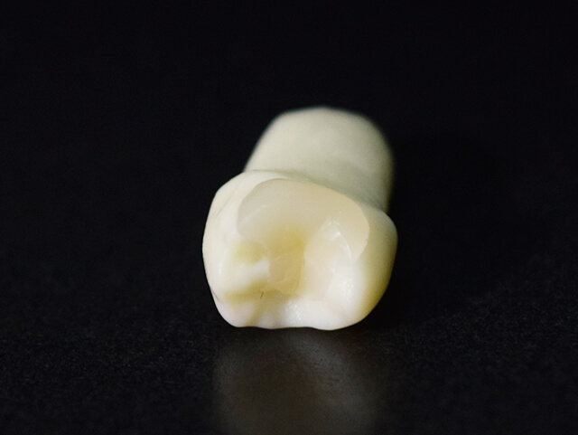 セラミックインレー