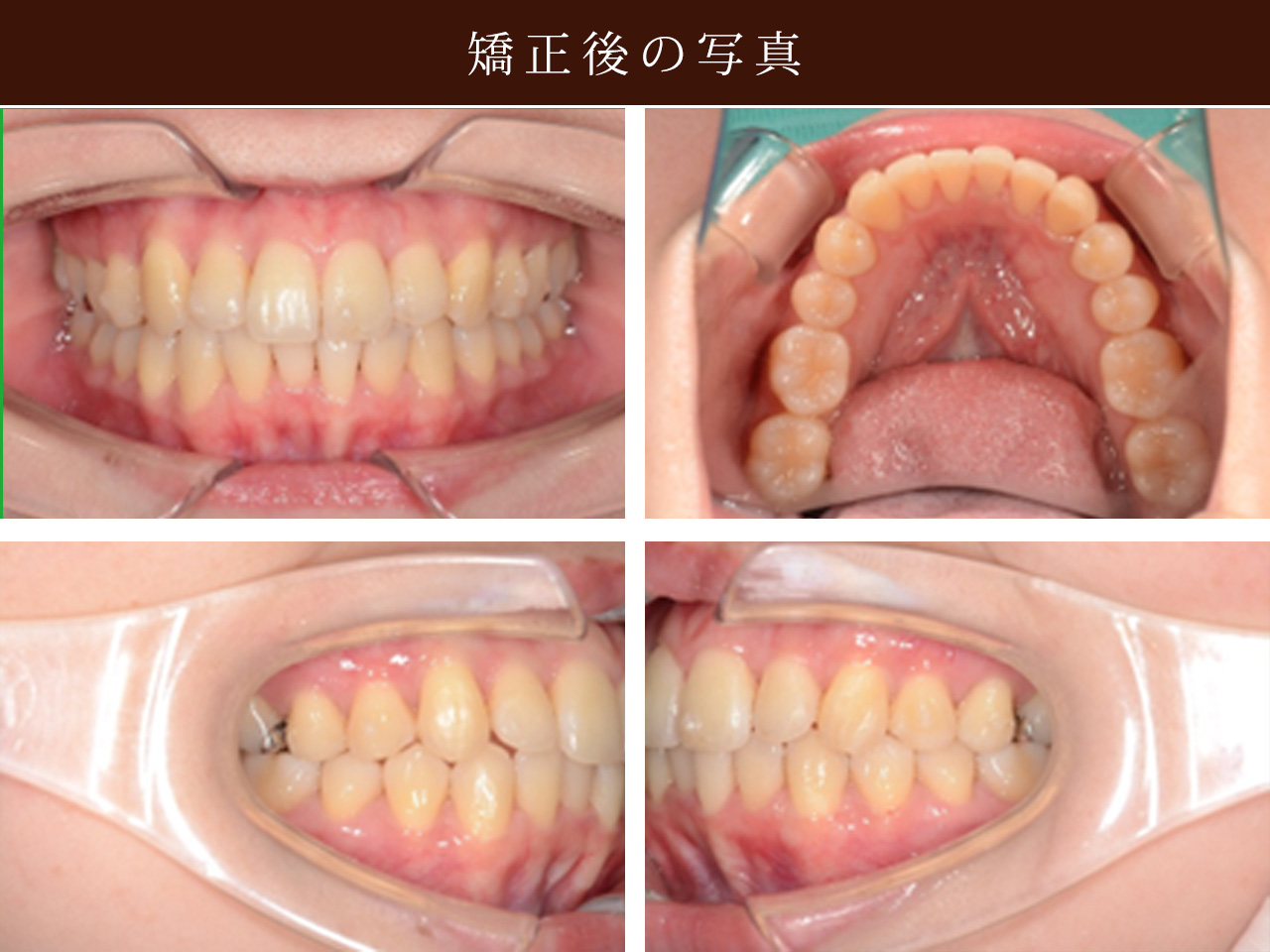 抜歯矯正のビフォーアフター