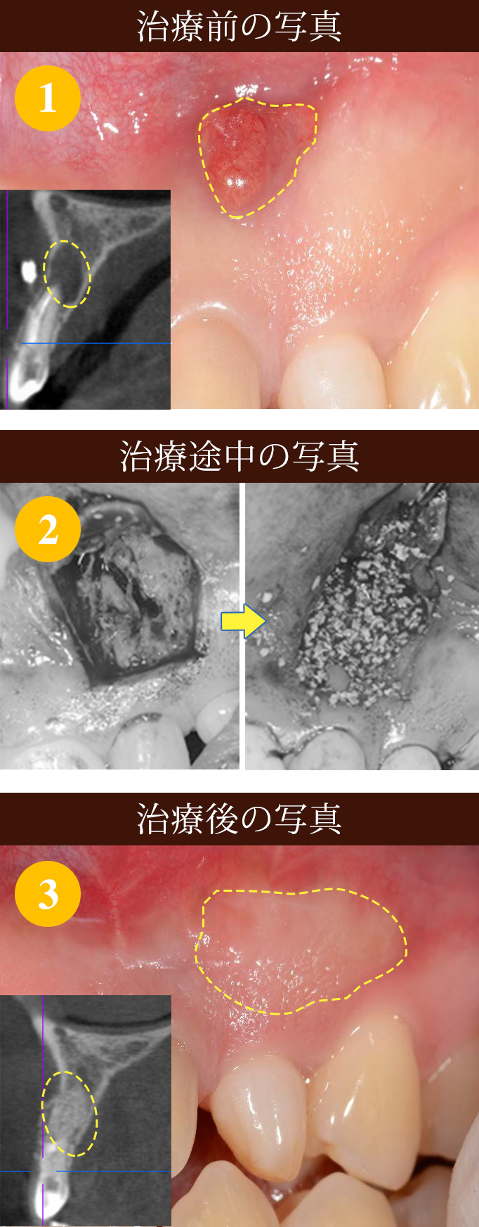 歯の根の治療 難治療 ①写真