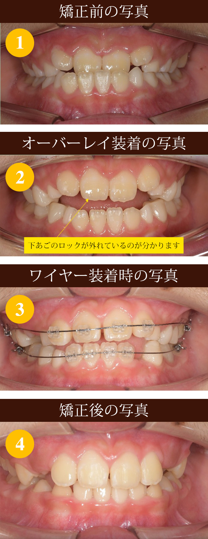反対咬合をオーバーレイで矯正Ⅱ
