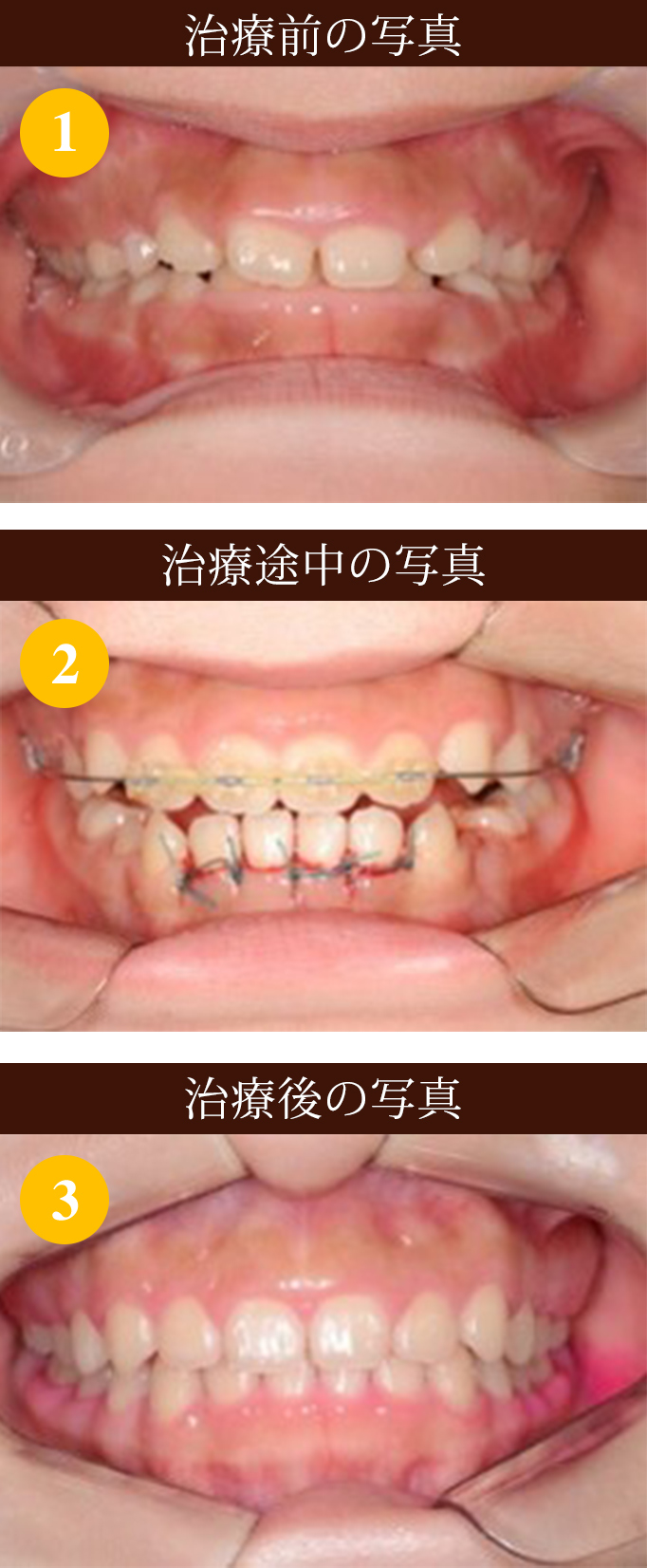 歯周外科 難治療 写真