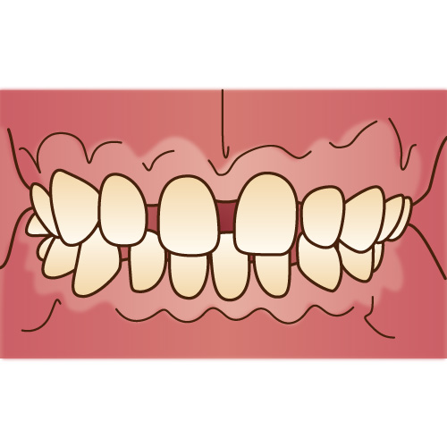 すきっ歯（空隙歯列） 