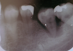 歯牙移植術レントゲン2週間後