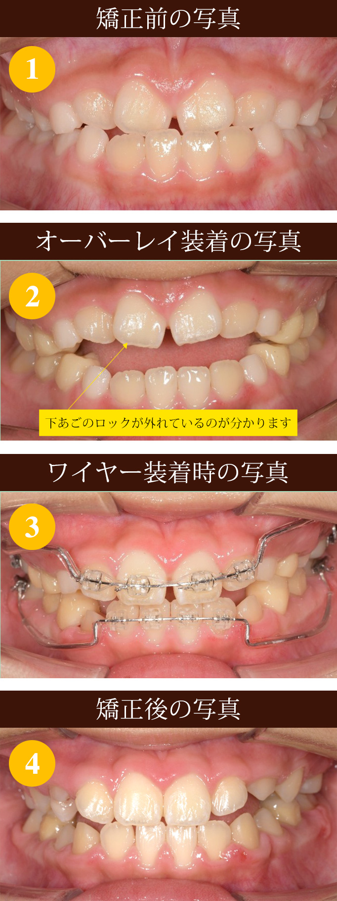 反対咬合をオーバーレイで矯正Ⅰ