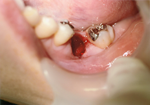 歯牙移植術写真