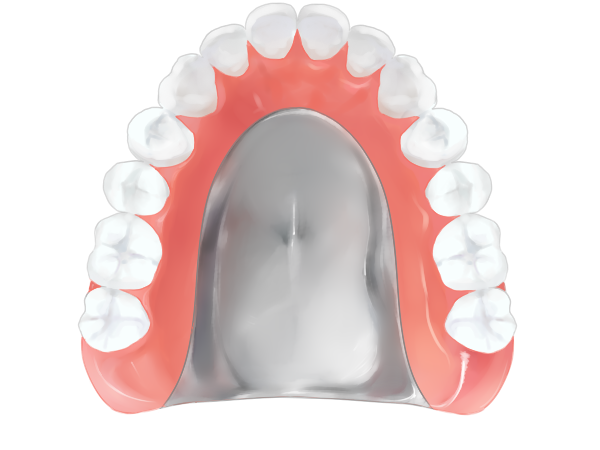 金属床義歯