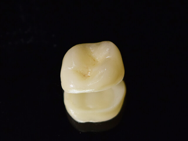 ジルコニアクラウン