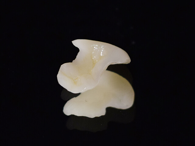 ジルコニアインレー