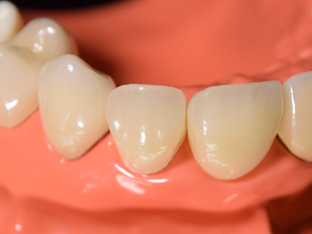 ジルコニア治療 - やはば歯科クリニック
