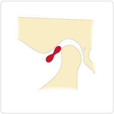 (パキッと音がする場合)