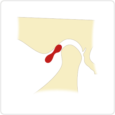 (口が開きにくい場合)