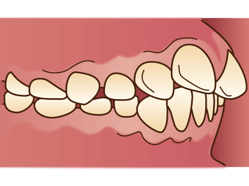上顎前突(じょうがくぜんとつ)