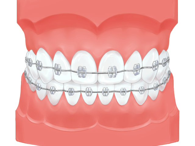 メタルブラケット