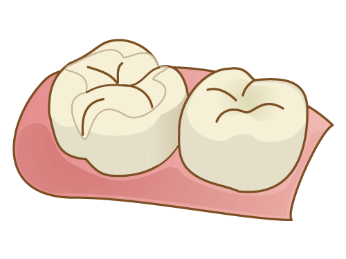 セラミックインレー