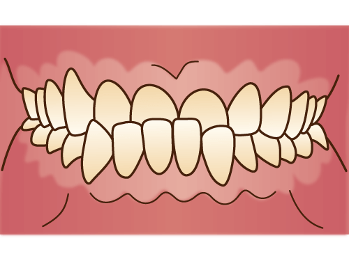 受け口(うけぐち)