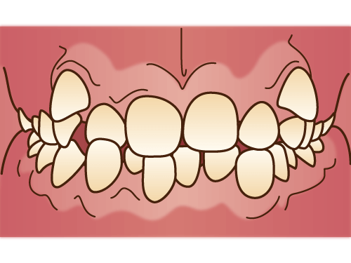 叢生(そうせい)