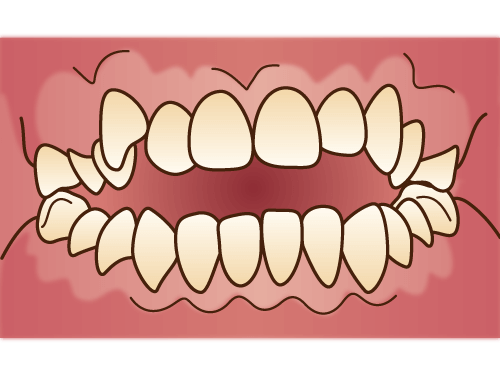 開咬(かいこう)