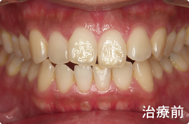 オフィスホワイトニング 水戸市にある歯医者 フカヤ歯科クリニック