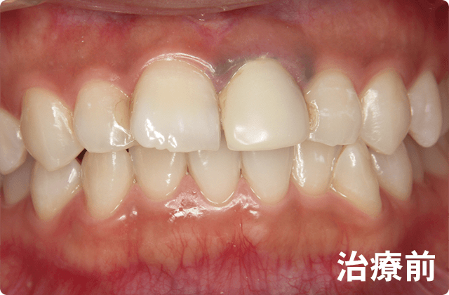 白い歯 水戸市にある歯医者 フカヤ歯科クリニック