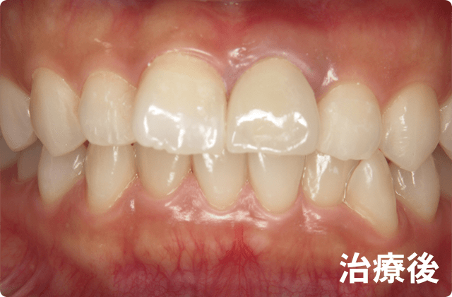 白い歯 水戸市にある歯医者 フカヤ歯科クリニック