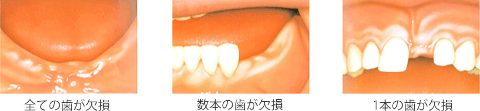 左：全ての歯が欠損、中：数本の歯が欠損、右：1本の歯が欠損