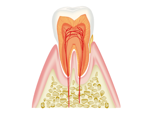 歯を失う主な原因　歯周病