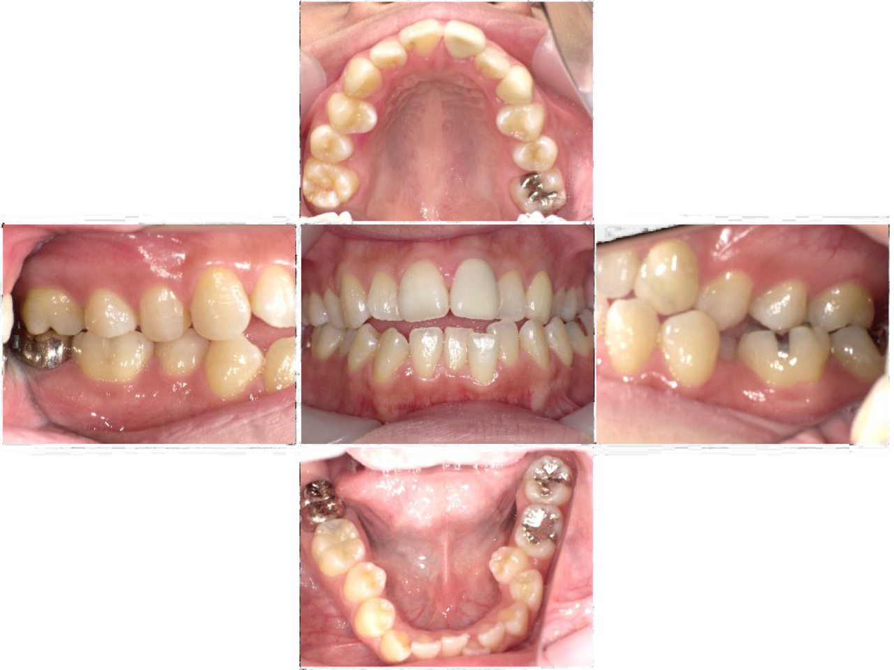 ジルコニアセラミック施術後