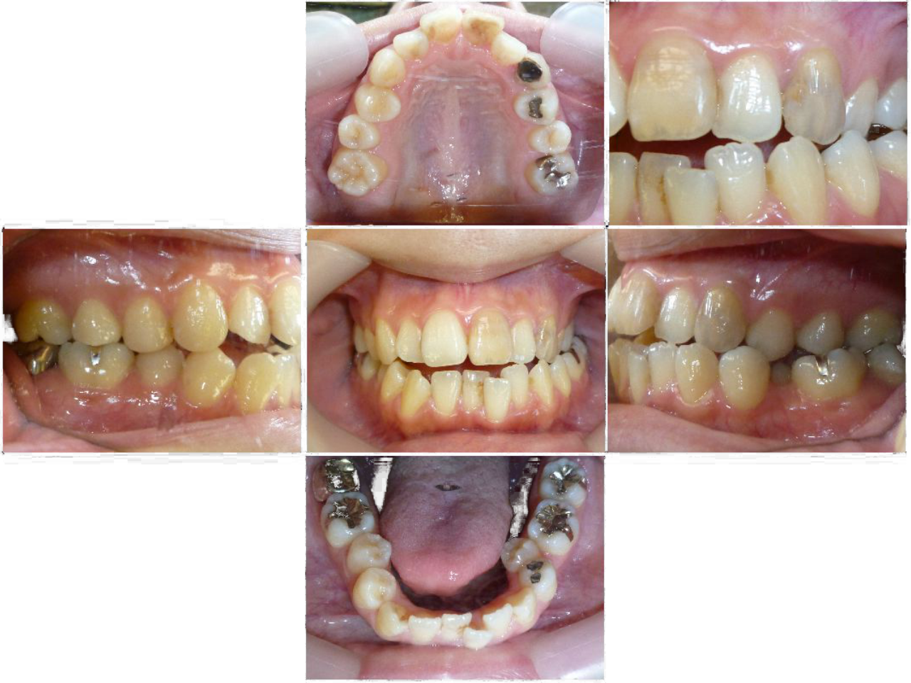 ジルコニアセラミック施術前