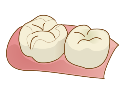 セラミックインレー