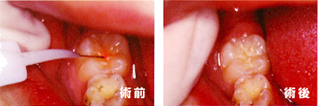 レーザー治療症例(術前・術後)