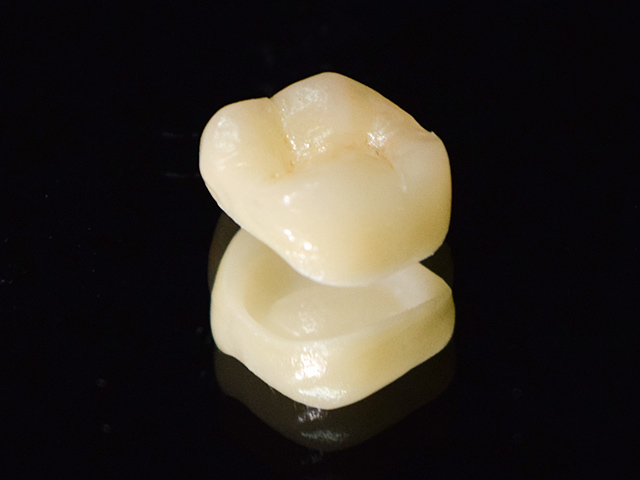 セレック(CEREC)とは?